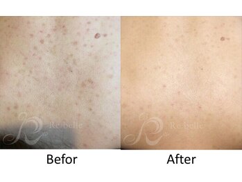 ベルメイク(BELLE MAKE)/リベル☆背中ビフォーアフター