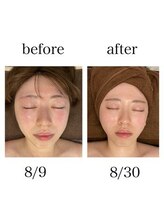 インディバケアプラチナム 横浜店/インディバ施術