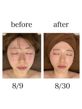 インディバケアプラチナム 横浜店/インディバ施術