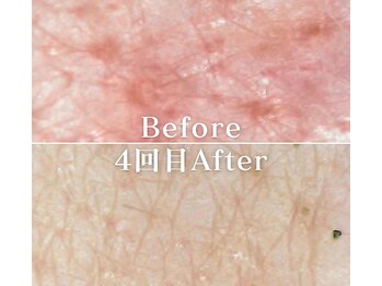 ミニョスキンラボ/韓国式ハーブピーリング4回