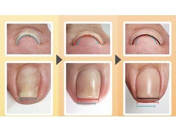 エンヴィ(ENVY)の写真/爪が小さい、薄い、足の巻き爪などのお悩みを解消！プロのネイルケアで美しく健康的な自爪を育成◎