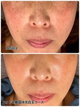 レイール(Reir)/ピーリング＋美白特化ケア　