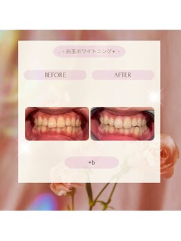 プラスビー 2号店(+b)/ホワイトニングビフォーアフター