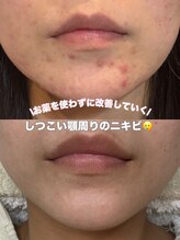 リリーラボ(LILY LAB)/しつこい顎ニキビに◎