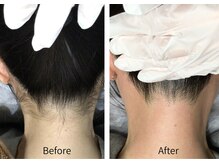 カルーナ 住吉店/うなじMIX脱毛