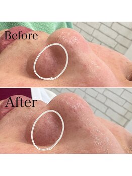 グランド ビューティー ビーズ 半田店(Grand Beauty B's)/毛穴ケア