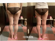 エステティックサロン 凜/3MAX3回施術後