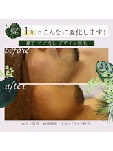 ラフラフ(Laf Laf)/髭脱毛