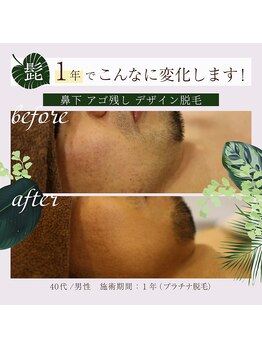 ラフラフ(Laf Laf)/髭脱毛