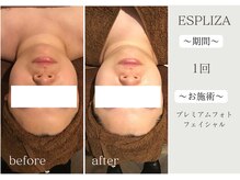 エスプライザ 横浜駅前店/一回でトーンUP！理想の白さに