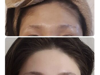 カヌヌ(kanunu)/部分脱毛/顔