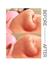 フィズ 新宿店(FIS)/☆毛穴洗浄☆［新宿三丁目］