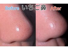 ハイパースリム 水天宮前店/頑固な毛穴の黒ずみもスッキリ！