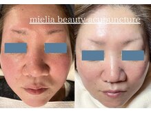 ミエリア美容鍼灸院(mielia美容鍼灸院)