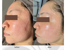 アン ビューティー(ann beauty)/施術3回【症例写真】30代