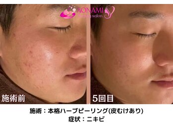 あおなみ はり きゅう整骨院/ハーブピーリング:ニキビ