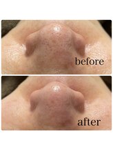 ノーブル(Noble)/最新!!ハイドラフェイシャル