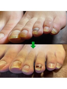 ビビィ(vivie)/手足のお悩み、お聞かせください