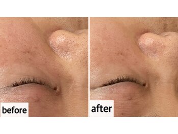 メナードフェイシャルサロン 岐阜茜部/ホワイトニングパック