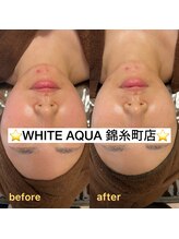 ホワイトアクア 錦糸町店(WHITE AQUA)/ハーブピーリング/東京/錦糸町