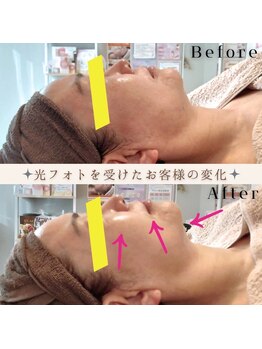 アミュレット(amulette)/大人気！光フォトトリートメント