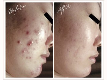 ミューベル(MYubelle)/トラブルケア 水光ピーリング