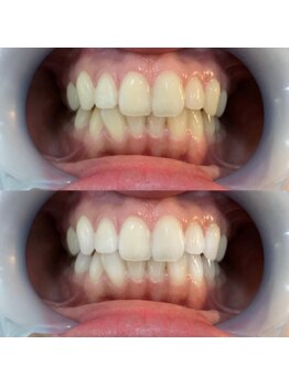 ラブホワイトニング 池袋店(LOVEホワイトニング)/ホワイトニング/ホワイトニング