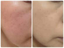 京都美顔/エイジングケア／乾燥・たるみ