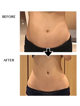 シンシア(sincere)/腹/ウエスト/凹凸脂肪ケア