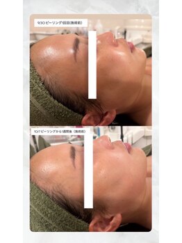 ビューティービューティー(beauty×beauty)/ハーブピーリングお客様結果