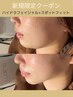 《毛穴洗浄×小顔たるみ改善》ハイドラ＋スポットフィット¥13000