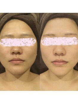 アユアランリンク 札幌店/20代前半/肌質改善/約2ヵ月