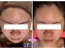 グリシーヌ(glycine)の雰囲気（ニキビ改善にお悩みの方、受賞歴のある当店にお任せください！）