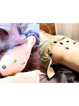 鍼灸施術を受けたい