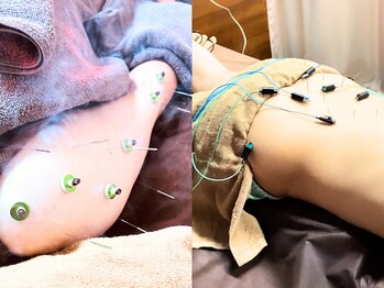 仁接骨院 じん鍼灸治療院の写真/【熟練の鍼灸師による本格施術】身体だけでなく頭や顔の鍼灸施術で全身疲労回復!お悩みを根本から改善★