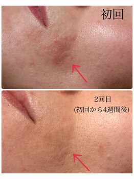 ベビースキン(baby skin)/肌改善