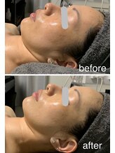 ラグ(LUXU)/艶肌小顔/リフトUP