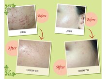 フロウ(FLOW)/OHLハーブピーリング