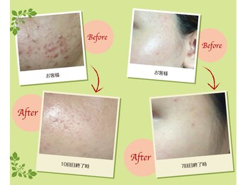 フロウ(FLOW)/OHLハーブピーリング