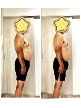 ラクア/リリスーカッター施術結果