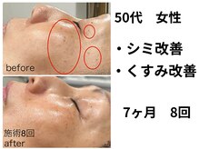 ビープラス(Biplus)/【50代お悩み】シミ・くすみ改善