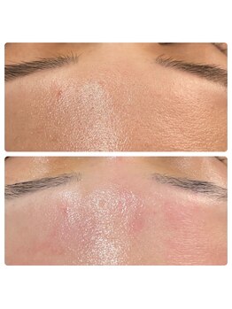 ティエット(tiet)/ハーブピーリング