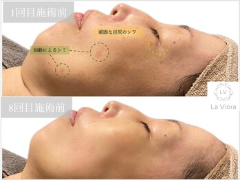 ラヴィオーラ 心斎橋店(La Viora)/ダイヤモンドハーブピーリング