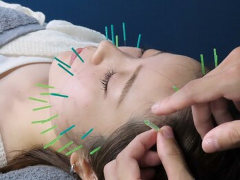 ハリット(haritt)の写真/美容鍼と小顔姿勢矯正のセットメニュー◆美しくなめらかな素肌へ♪割引もご用意♪《¥12000円→4000円》