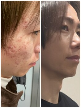 メンズサロンエヌエー(MEN'S SALON NA)/【男のスキンケア】体現しました