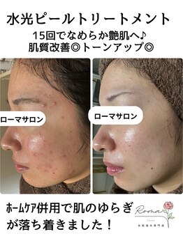 ローマサロン/水光ピールトリートメント