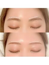 ルフラン(Refrain)/左右差改善/形矯正　