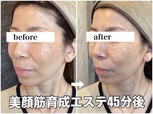 リエル(RIEL)/小顔矯正×美顔筋育成エステ