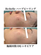 サラ/ハーブピーリング