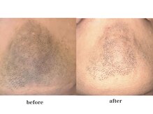 カヌヌ(kanunu)/メンズ脱毛/髭・顔